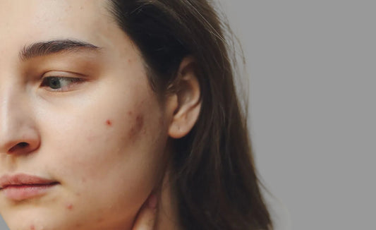 Woman with dry, breakout-prone skin and visible blemishes on her cheek